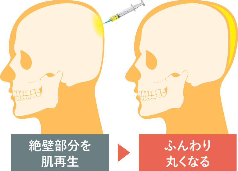 PRPG注入治療で”後頭部を形成する”とは