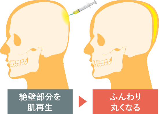 PRPG注入治療で”後頭部を形成する”とは