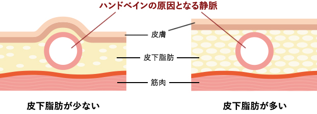 皮下脂肪量の減少