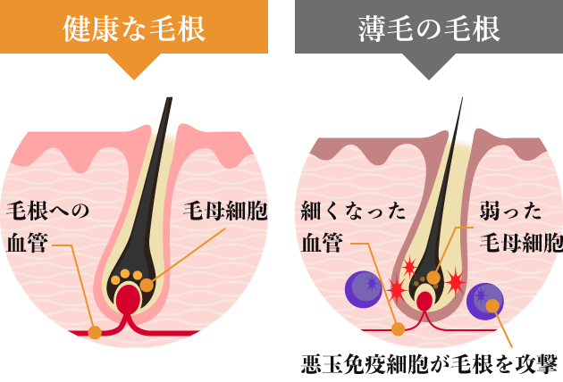 薄毛の毛根の特徴