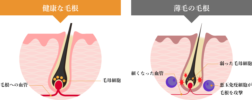 薄毛の毛根の特徴