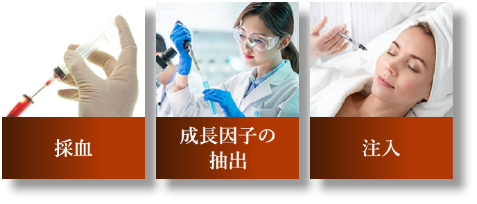 採血 成長因子の抽出 注入