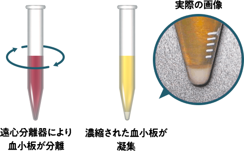 遠心分離器により血小板が分離