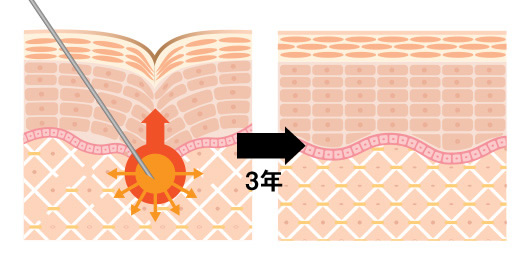 ぷるぷる注射 for MENは、薬剤の注入治療などのように、数ヶ月で効果が切れるのではありません。