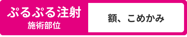 ぷるぷる注射施術部位：額、こめかみ