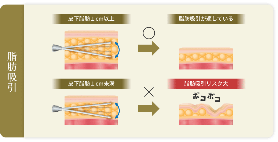 脂肪吸引