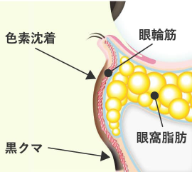 Step 1 目の下のふくらみに加えて、茶クマや黒クマ（影クマ）を伴ったクマ