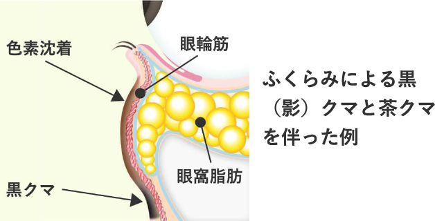 Step 1 目の下のふくらみに加えて、茶クマや黒クマ（影クマ）を伴ったクマ