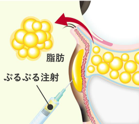 Step 2 下まぶたの裏側（結膜）から余分な脂肪を取り、同時にクマの原因部にぷるぷる注射を行う