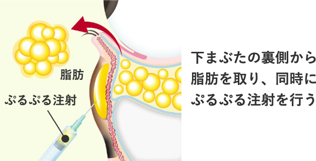 Step 2 下まぶたの裏側（結膜）から余分な脂肪を取り、同時にクマの原因部にぷるぷる注射を行う