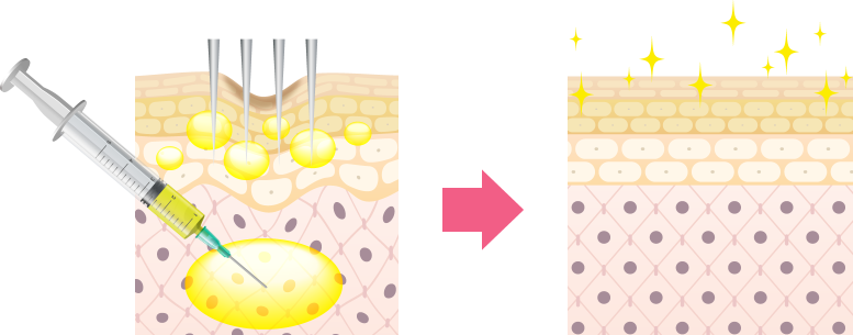 ぷるぷる注射の二層注入