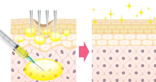 ぷるぷる注射の二層注入