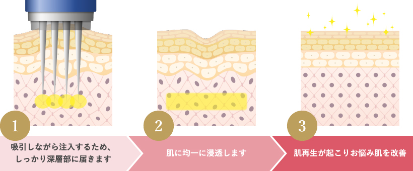 吸引しながら注入するため、しっかり深層部に届きます 肌に均一に浸透します 肌再生が起こりお悩み肌を改善