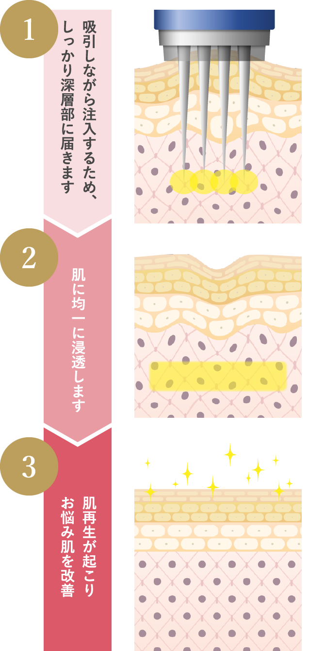 吸引しながら注入するため、しっかり深層部に届きます 肌に均一に浸透します 肌再生が起こりお悩み肌を改善